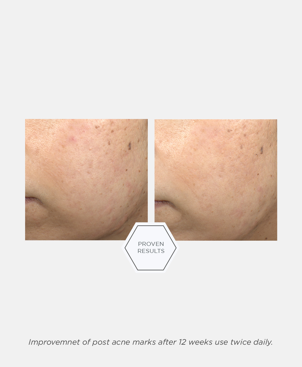 30307-neo-post-acne-mark-correcting-serum_v5_1